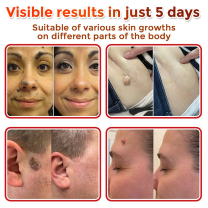 🌈GFOUK® MicroNeedle Botanic Skin Tag Removal Patch 🇺🇸 Made in the USA