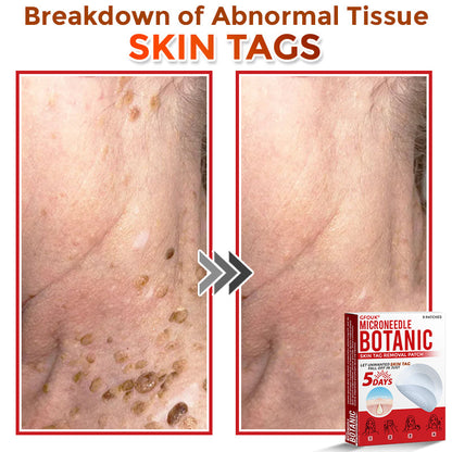 🌈GFOUK® MicroNeedle Botanic Skin Tag Removal Patch 🇺🇸 Made in the USA