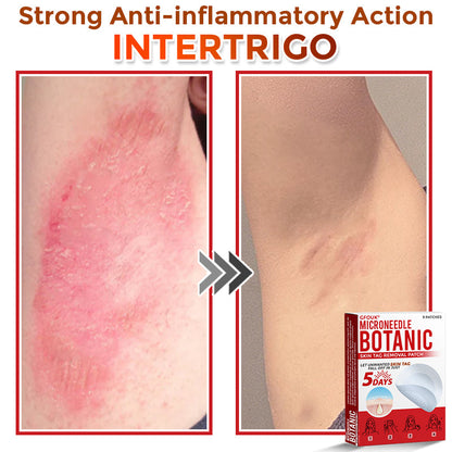 🌈GFOUK® MicroNeedle Botanic Skin Tag Removal Patch 🇺🇸 Made in the USA