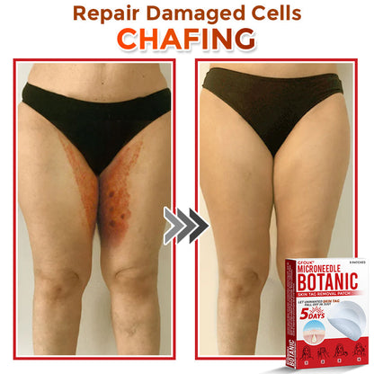 🌈GFOUK® MicroNeedle Botanic Skin Tag Removal Patch 🇺🇸 Made in the USA