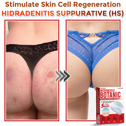 🌈GFOUK® MicroNeedle Botanic Skin Tag Removal Patch 🇺🇸 Made in the USA
