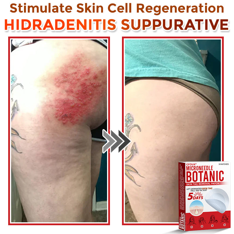 🌈GFOUK® MicroNeedle Botanic Skin Tag Removal Patch 🇺🇸 Made in the USA