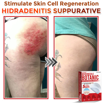 🌈GFOUK® MicroNeedle Botanic Skin Tag Removal Patch 🇺🇸 Made in the USA
