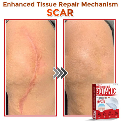 🌈GFOUK® MicroNeedle Botanic Skin Tag Removal Patch 🇺🇸 Made in the USA